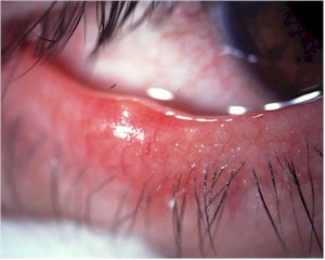 orzuelo-tratamiento-remedio-dolor-y-molestias-clinica-oftalmologia.jpg